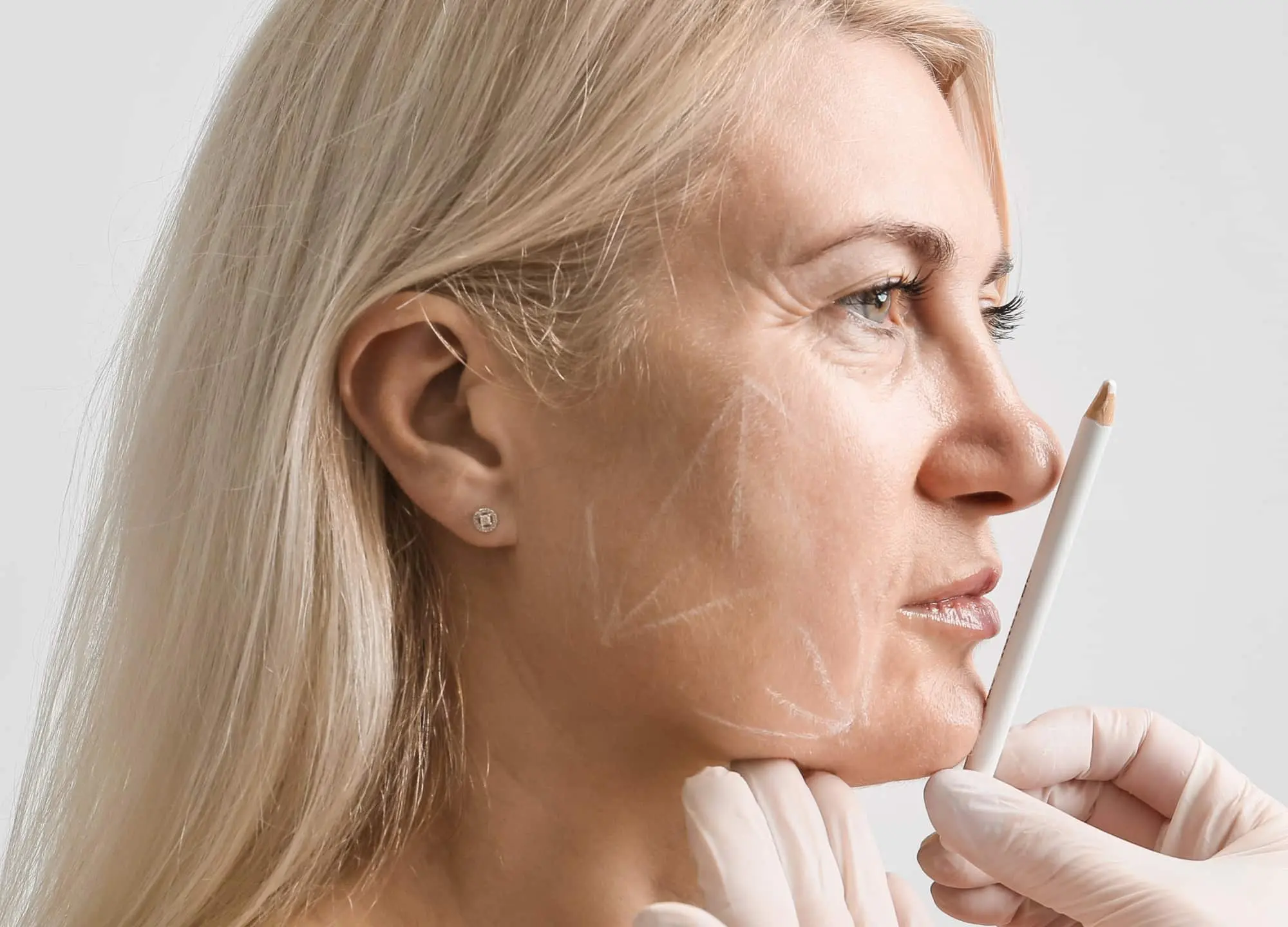 Facelift surgery at Yesilkoy Medical Center