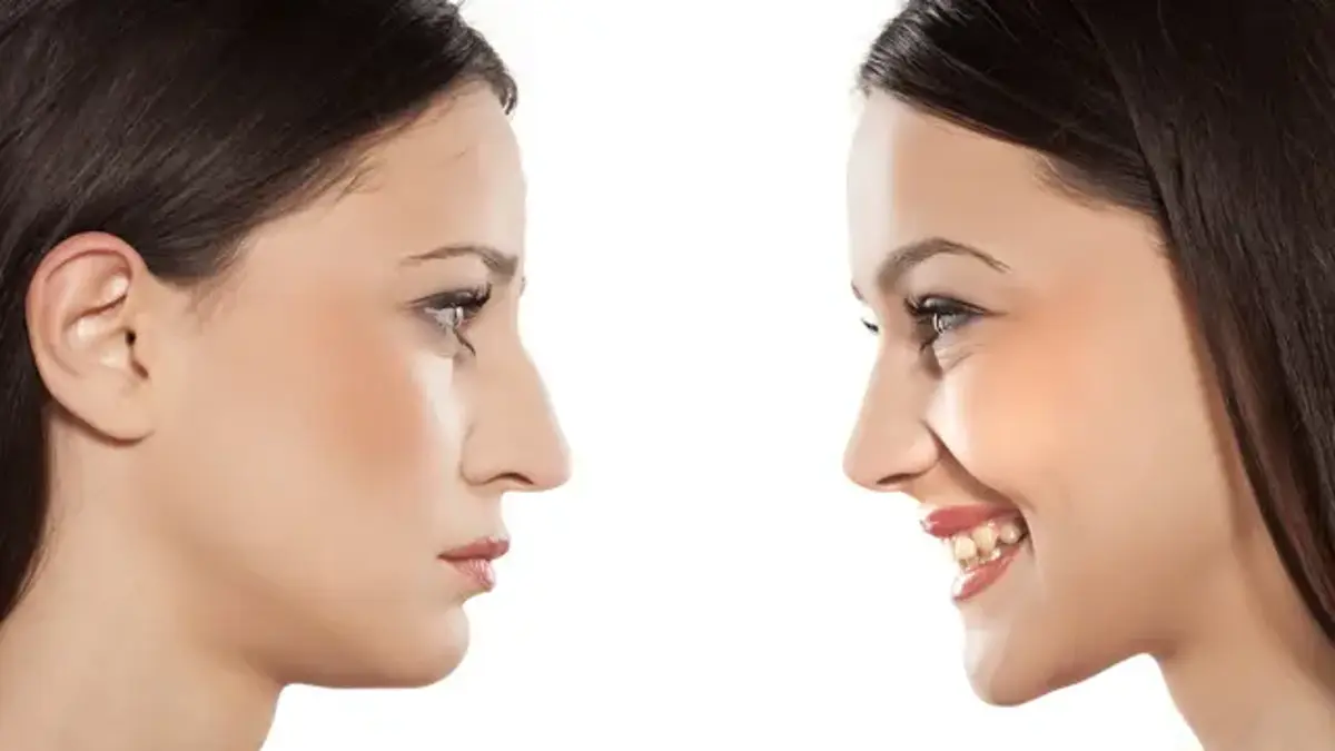 Rhinoplasty at Yesilkoy Medical Center